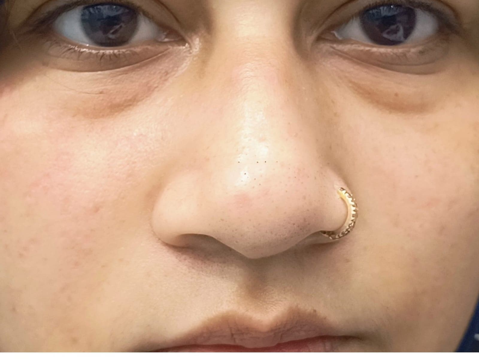 After Freckles Removal at SZ Clinic — patient result