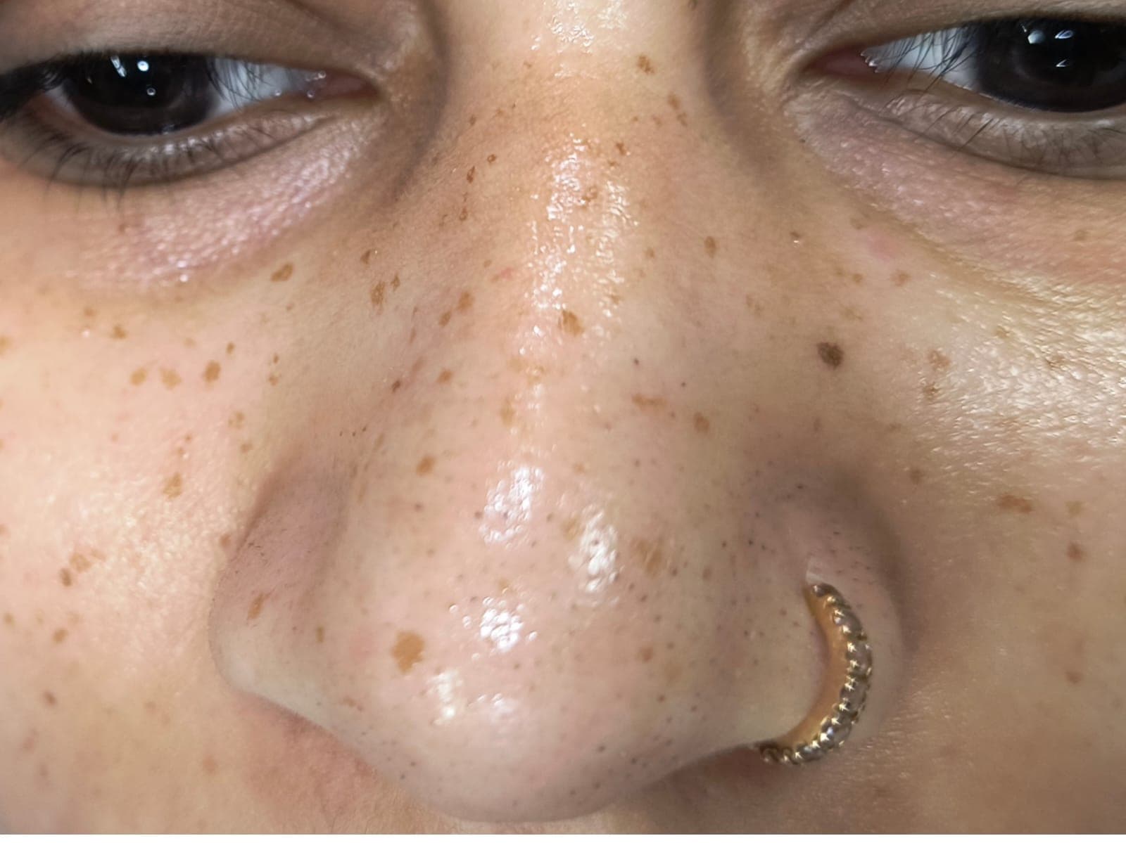 Before Freckles Removal at SZ Clinic — initial condition